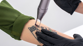 Remoção de tatuagem